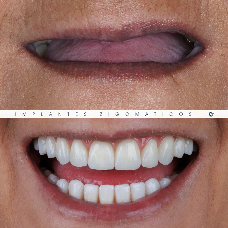 Sorriso antes e depois de implantes zigomáticos, caso 1