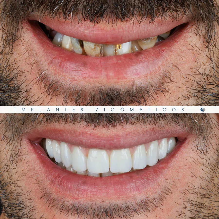 Sorriso antes e depois de implantes zigomáticos, caso 2