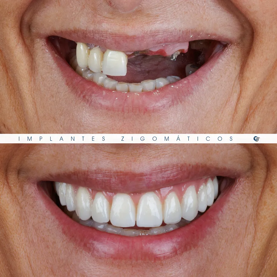 Sorriso antes e depois de implantes zigomáticos, caso 3