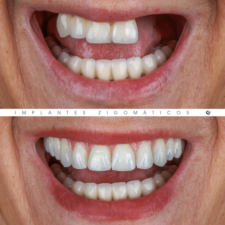 Sorriso antes e depois de implantes zigomáticos, caso 4